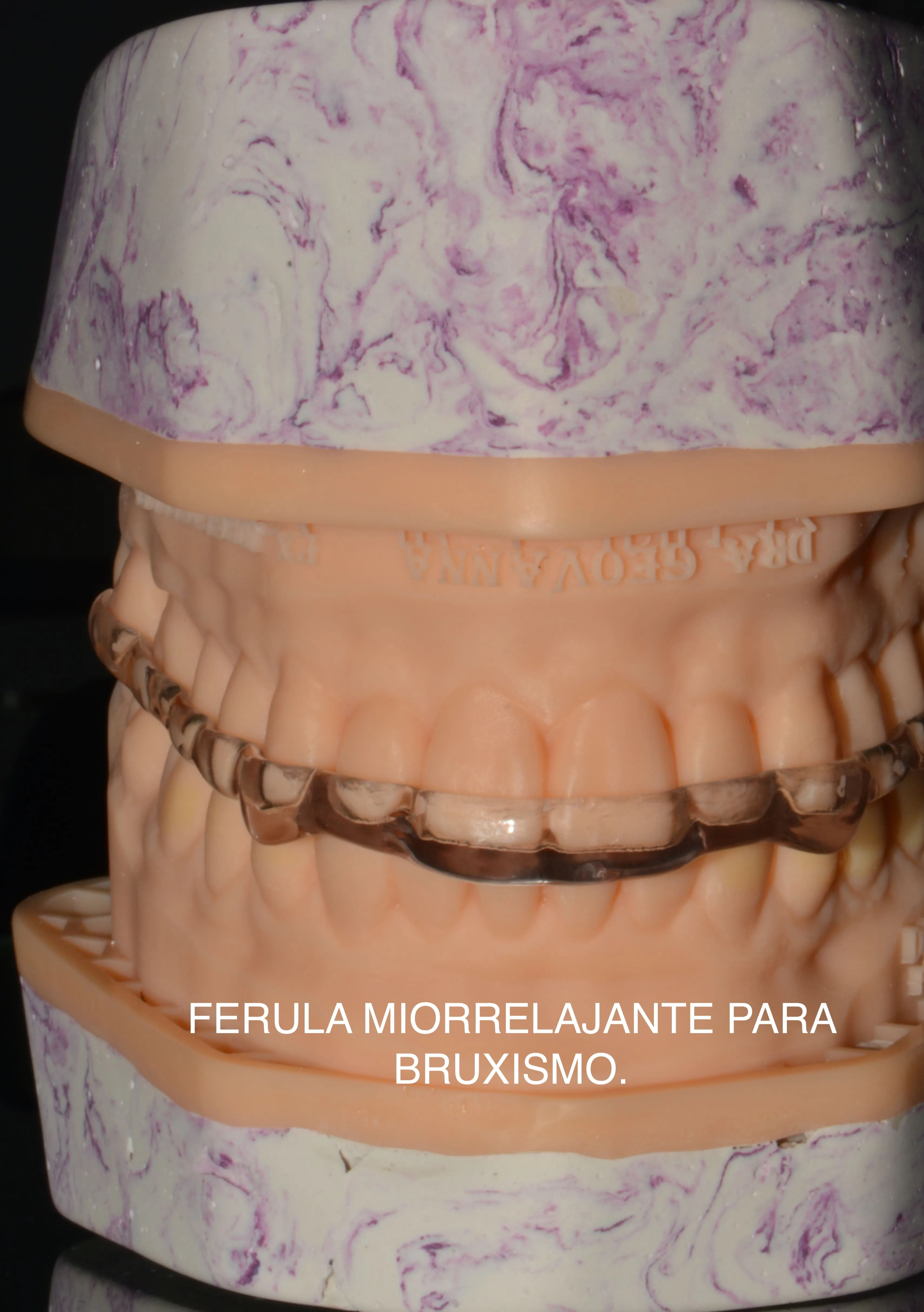 Férulas de descarga para bruxismo