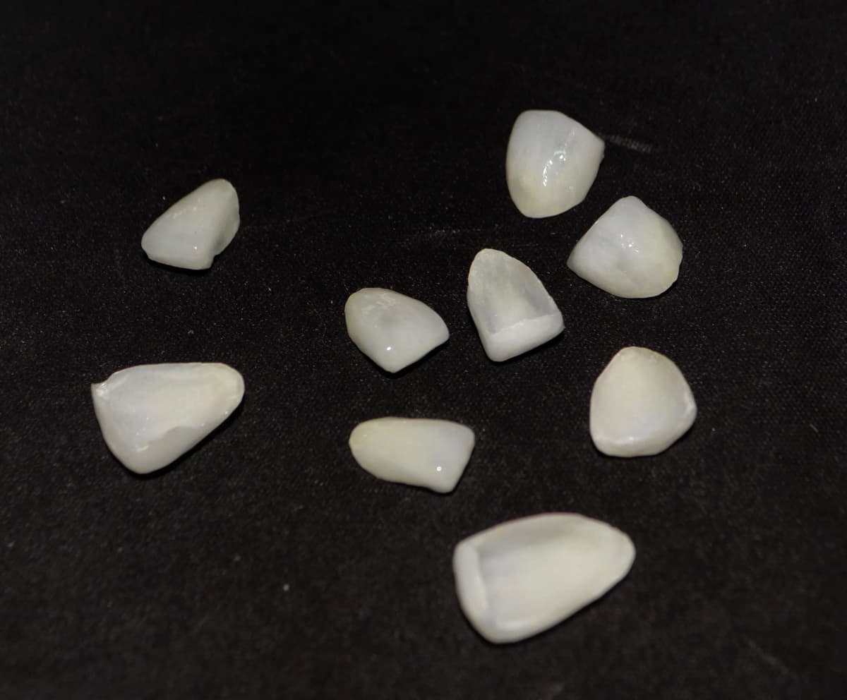 Carillas dentales en porcelana