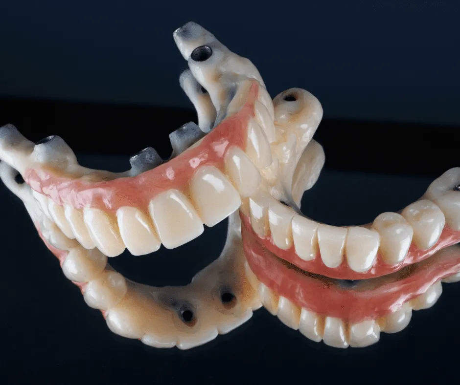 Prótesis fijas sobre implantes