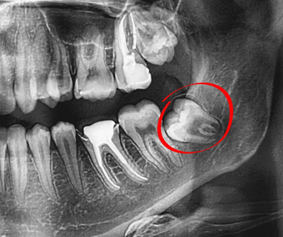 Tratamiento de cirugías menores especializadas - Extracciones dentales
