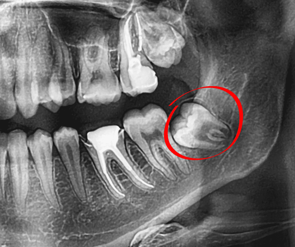 Tratamiento de cirugías menores especializadas - Extracciones dentales